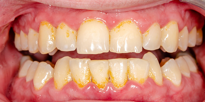 Sarro dental: ¿Cómo eliminarlo?