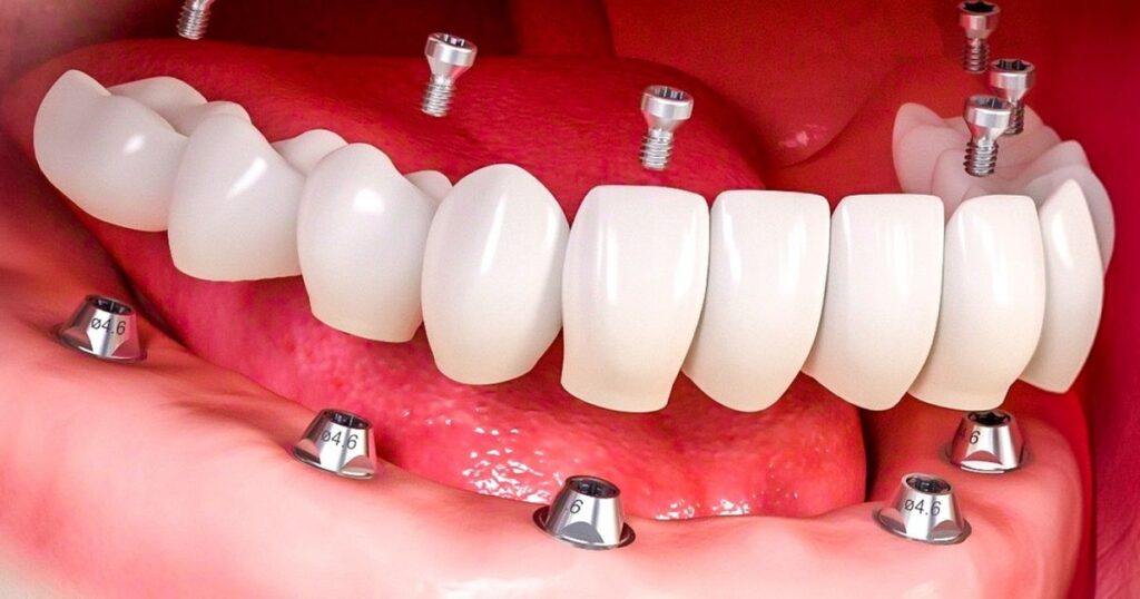 BEGADENT COYOACÁN | Implantes dentales