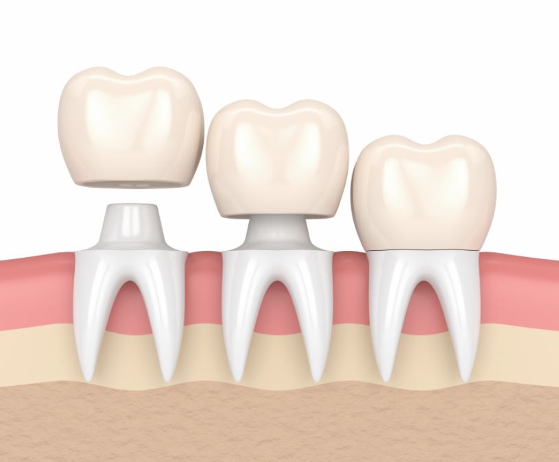 Las coronas dentales: Todo lo que necesitas saber