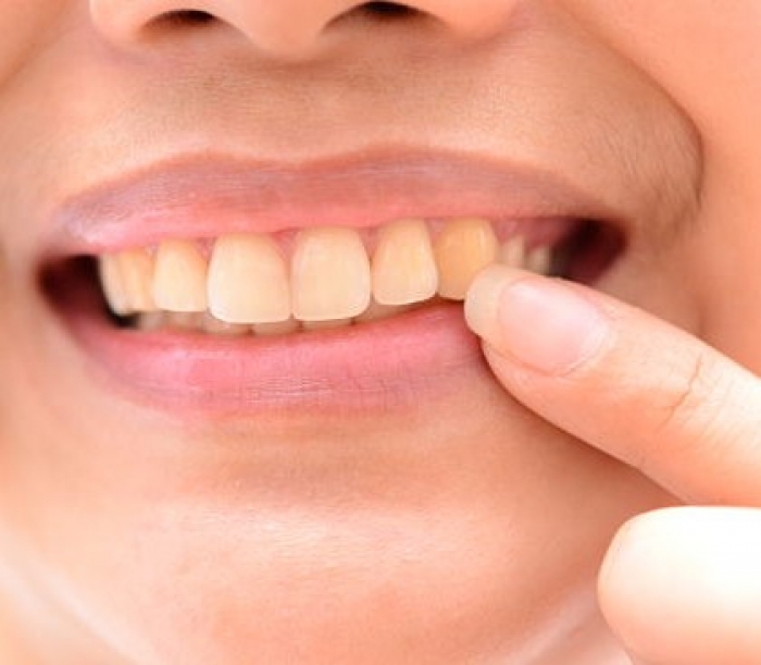 Las manchas en los dientes | Dentistas en Coyoacán